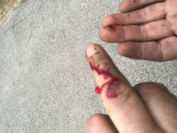 Bleeding Finger